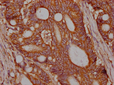IHC image of MET Recombinant Monoclonal Antibody diluted at 1:100 and staining in paraffin-embedded human colon cancer performed on a Leica BondTM system. After dewaxing and hydration, antigen retrieval was mediated by high pressure in a citrate buffer (pH 6.0). Section was blocked with 10% normal goat serum 30min at RT. Then primary antibody (1% BSA) was incubated at 4℃ overnight. The primary is detected by a Goat anti-rabbit IgG polymer labeled by HRP and visualized using 0.05% DAB.MET Recombinant Monoclonal Antibody