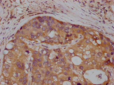 IHC image of MET Recombinant Monoclonal Antibody diluted at 1:100 and staining in paraffin-embedded human liver cancer performed on a Leica BondTM system. After dewaxing and hydration, antigen retrieval was mediated by high pressure in a citrate buffer (pH 6.0). Section was blocked with 10% normal goat serum 30min at RT. Then primary antibody (1% BSA) was incubated at 4℃ overnight. The primary is detected by a Goat anti-rabbit IgG polymer labeled by HRP and visualized using 0.05% DAB.MET Recombinant Monoclonal Antibody