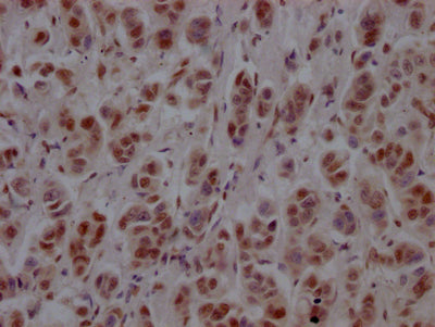 IHC image of PTBP1 Recombinant Monoclonal Antibody diluted at 1:100 and staining in paraffin-embedded human breast cancer performed on a Leica BondTM system. After dewaxing and hydration, antigen retrieval was mediated by high pressure in a citrate buffer (pH 6.0). Section was blocked with 10% normal goat serum 30min at RT. Then primary antibody (1% BSA) was incubated at 4℃ overnight. The primary is detected by a Goat anti-rabbit IgG polymer labeled by HRP and visualized using 0.05% DAB.PTBP1 Recombinant Monoclonal Antibody