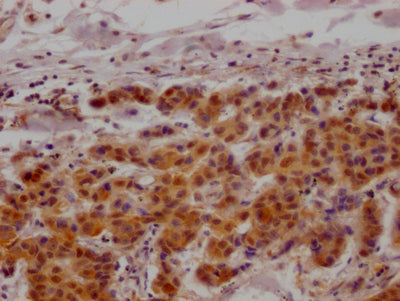 IHC image of MAPKAPK2 Recombinant Monoclonal Antibody diluted at 1:100 and staining in paraffin-embedded human breast cancer performed on a Leica BondTM system. After dewaxing and hydration, antigen retrieval was mediated by high pressure in a citrate buffer (pH 6.0). Section was blocked with 10% normal goat serum 30min at RT. Then primary antibody (1% BSA) was incubated at 4℃ overnight. The primary is detected by a Goat anti-rabbit IgG polymer labeled by HRP and visualized using 0.05% DAB.MAPKAPK2 Recombinant Monoclonal Antibody