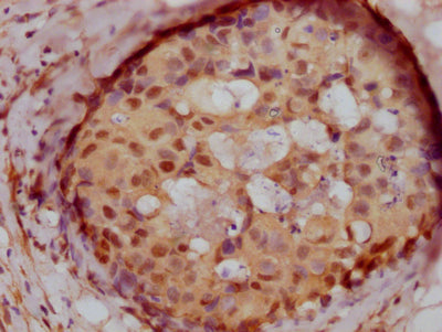IHC image of PELP1 Recombinant Monoclonal Antibody diluted at 1:100 and staining in paraffin-embedded human breast cancer performed on a Leica BondTM system. After dewaxing and hydration, antigen retrieval was mediated by high pressure in a citrate buffer (pH 6.0). Section was blocked with 10% normal goat serum 30min at RT. Then primary antibody (1% BSA) was incubated at 4℃ overnight. The primary is detected by a Goat anti-rabbit IgG polymer labeled by HRP and visualized using 0.05% DAB.PELP1 Recombinant Monoclonal Antibody