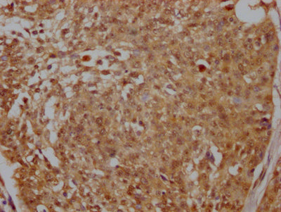 IHC image of PELP1 Recombinant Monoclonal Antibody diluted at 1:100 and staining in paraffin-embedded human cervical cancer performed on a Leica BondTM system. After dewaxing and hydration, antigen retrieval was mediated by high pressure in a citrate buffer (pH 6.0). Section was blocked with 10% normal goat serum 30min at RT. Then primary antibody (1% BSA) was incubated at 4℃ overnight. The primary is detected by a Goat anti-rabbit IgG polymer labeled by HRP and visualized using 0.05% DAB.PELP1 Recombinant Monoclonal Antibody